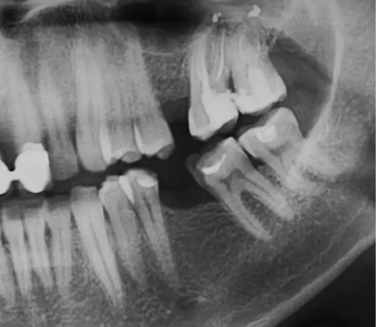Dental X-ray